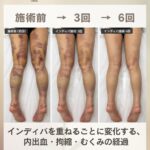 脂肪吸引後の脚の経過 施術前と3回目・6回目