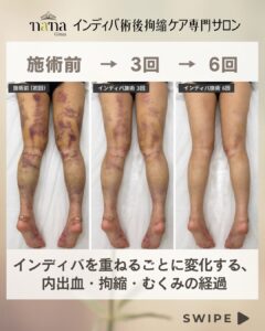 脂肪吸引後の脚の経過 施術前と3回目・6回目