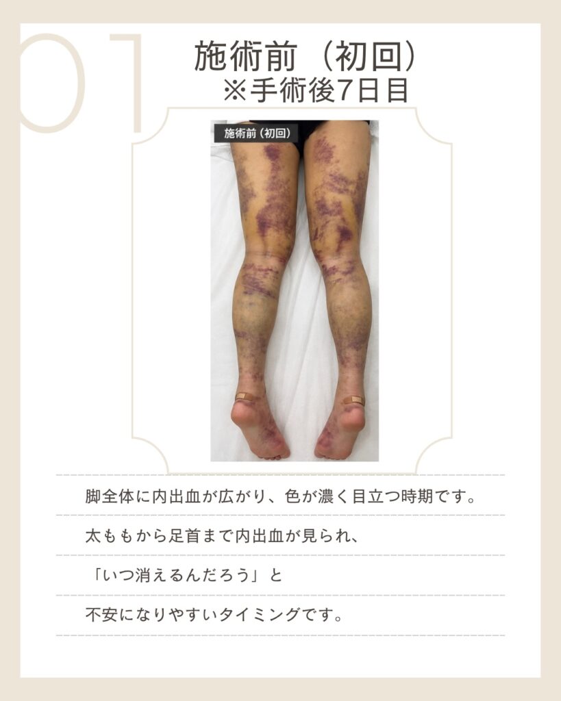 脂肪吸引 手術後7日目の脚 内出血