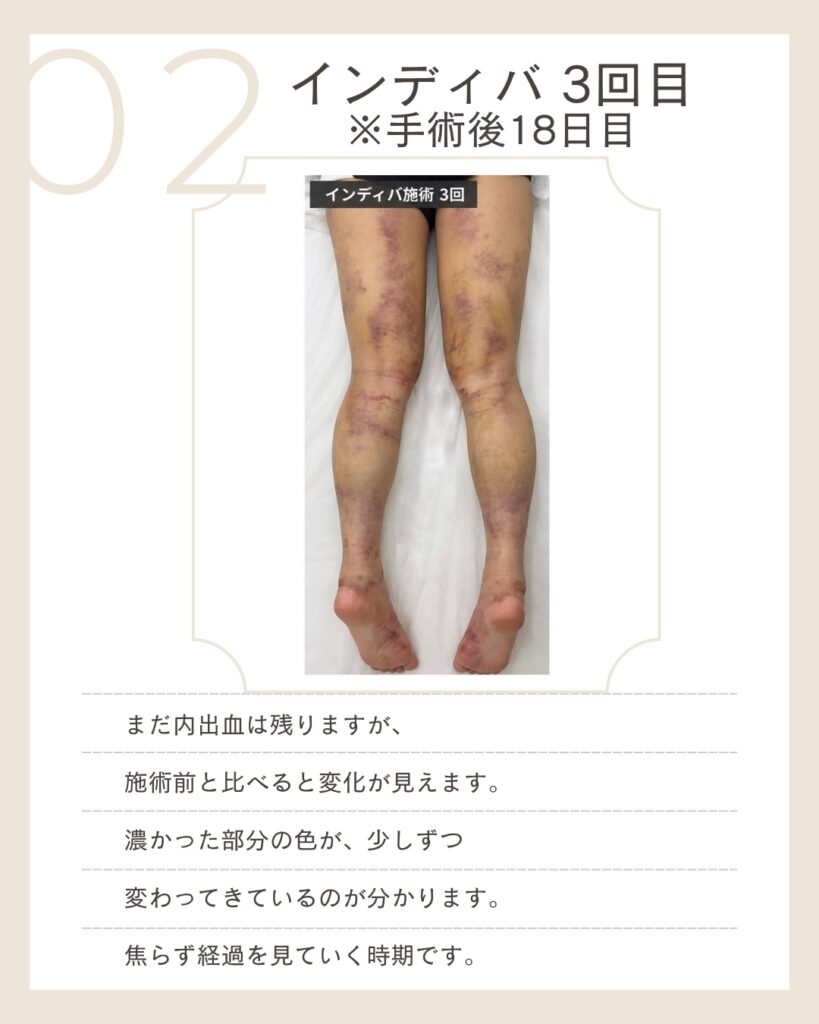 脂肪吸引 手術後18日目 インディバ3回目の脚