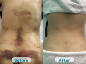インディバ術後拘縮ケア 背中のBefore/After