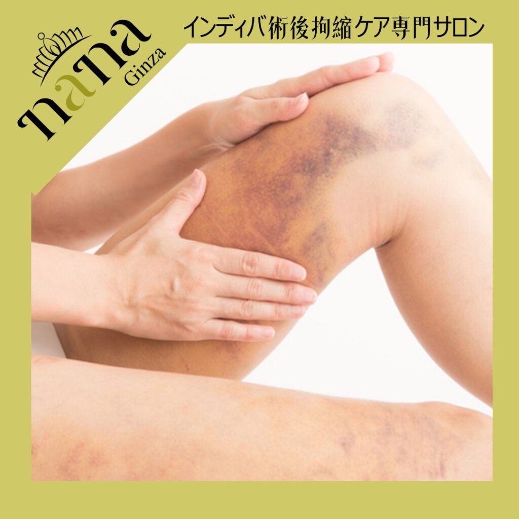 太ももの内出血を手で確認する様子