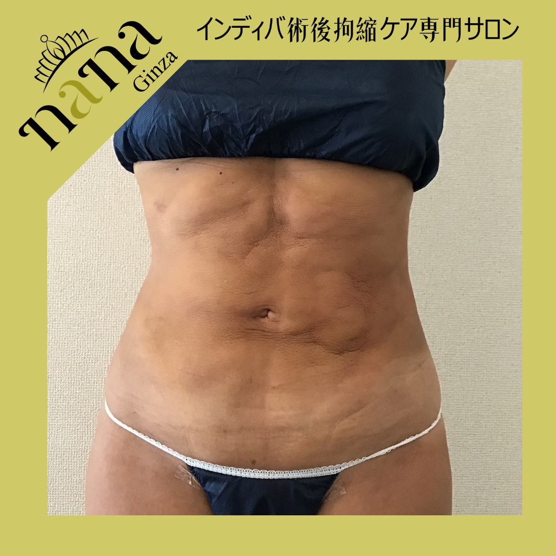 インディバ術後拘縮ケア お腹の状態